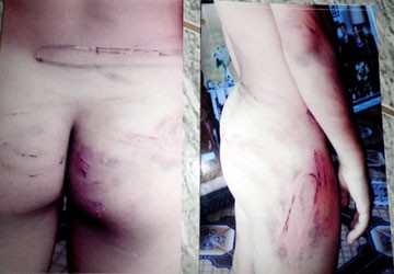 Những vết thương chi chít trên người của em Thuận. Ảnh: Vn Media